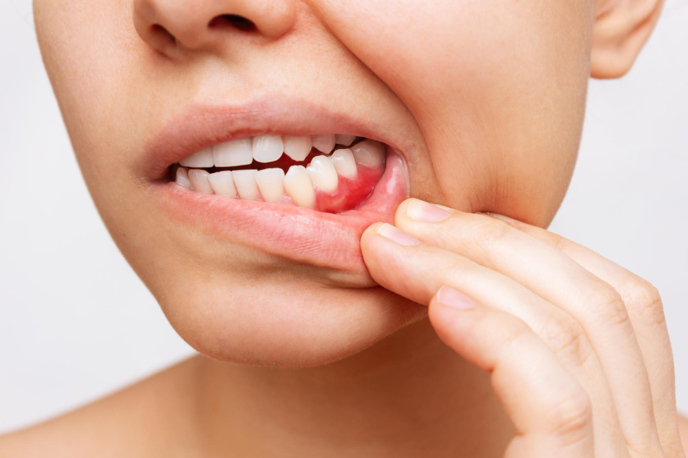 Gum treatment