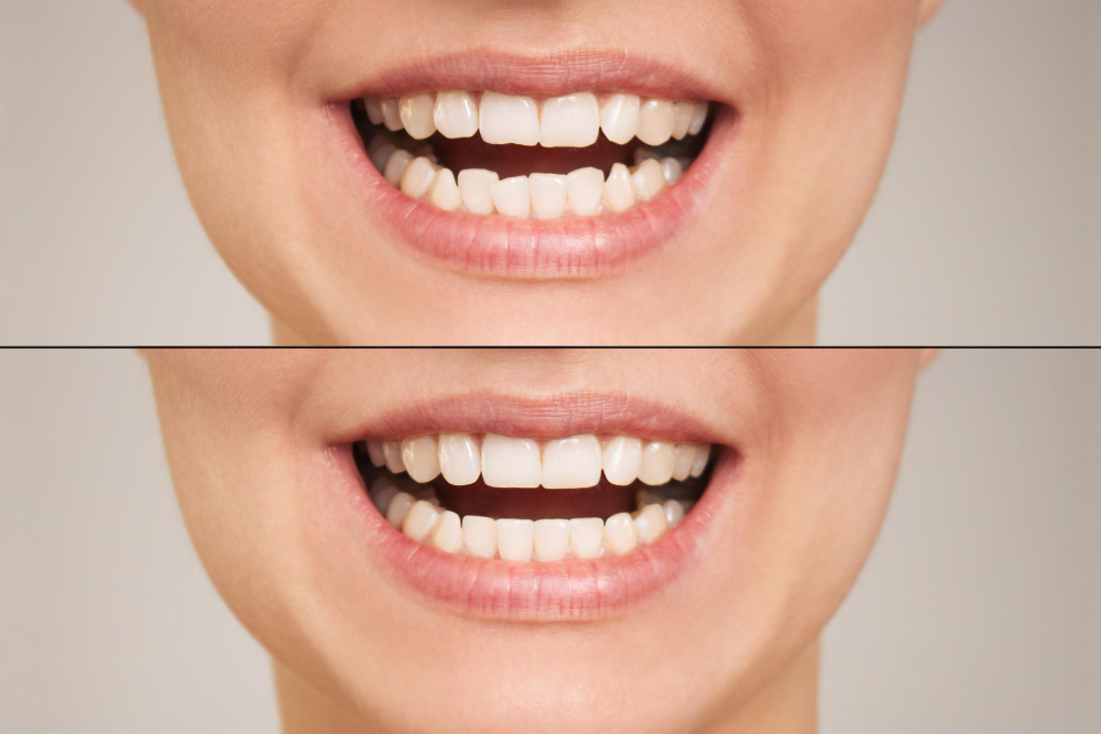 Smile designing